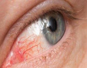 تعرف على كيفية الوقاية من الإصابة بـ”العين الوردية”.. التفاصيل هنا !!